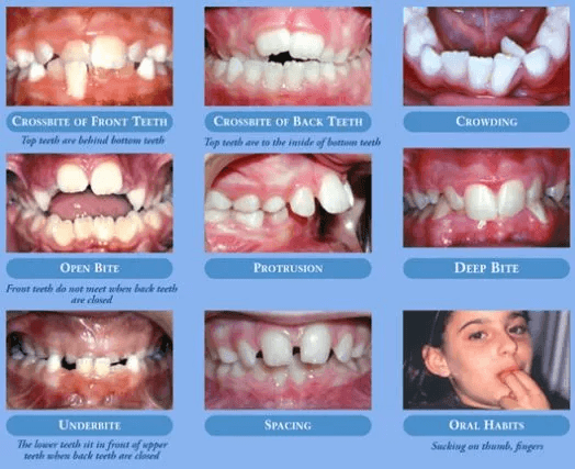 Malocclusions “bad bites"